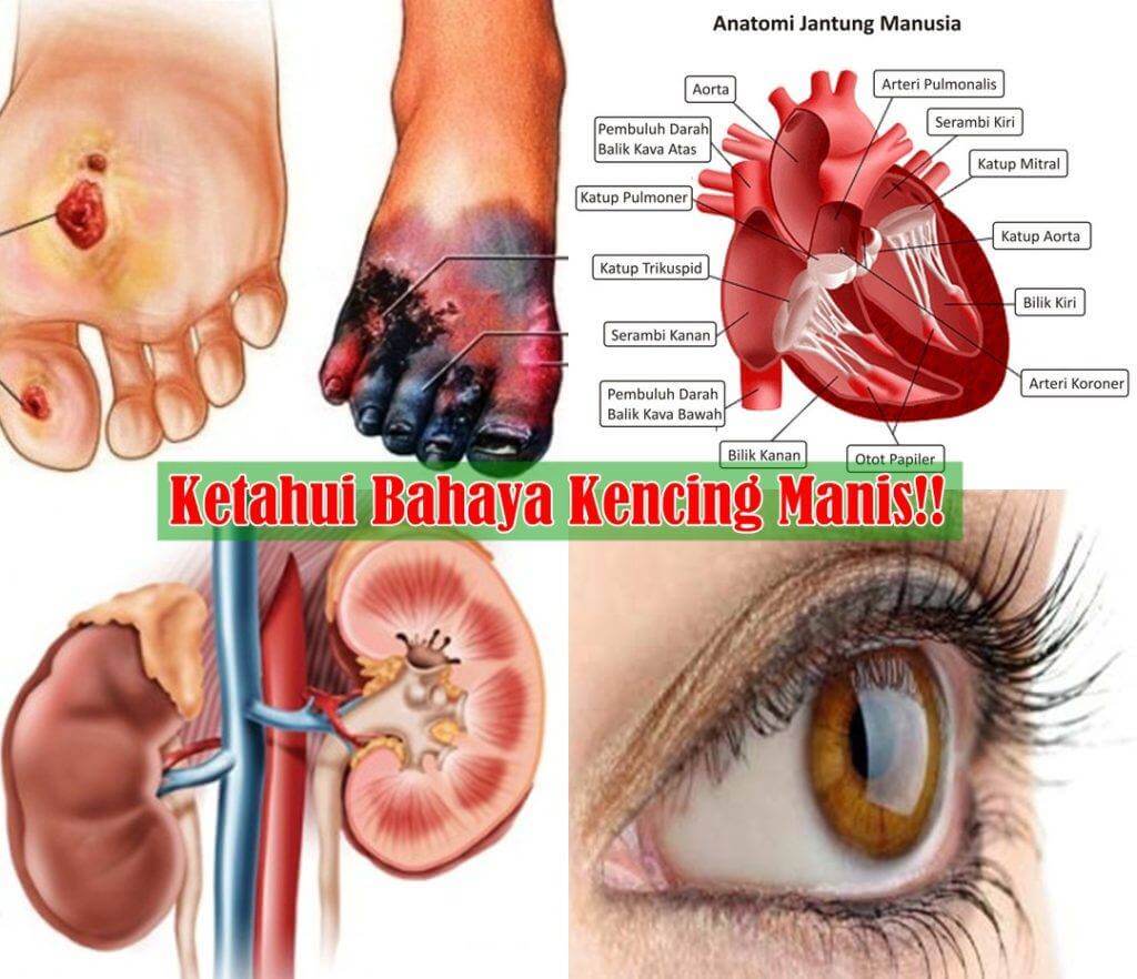 Awas penyakit kencing manis pembunuh dalam senyap!